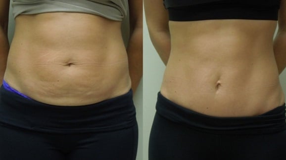 Dermolipectomy & Abdominoplasty - Specialized Plastic Surgery in Lima